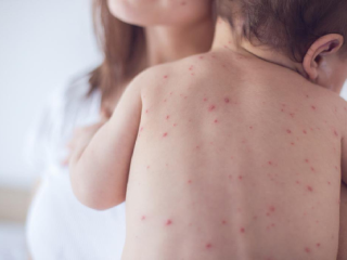 Bệnh sởi là một bệnh truyền nhiễm cấp tính do virus gây ra, thường gặp ở trẻ em. Dưới đây là những dấu hiệu quan trọng của bệnh sởi mà cha mẹ cần biết: